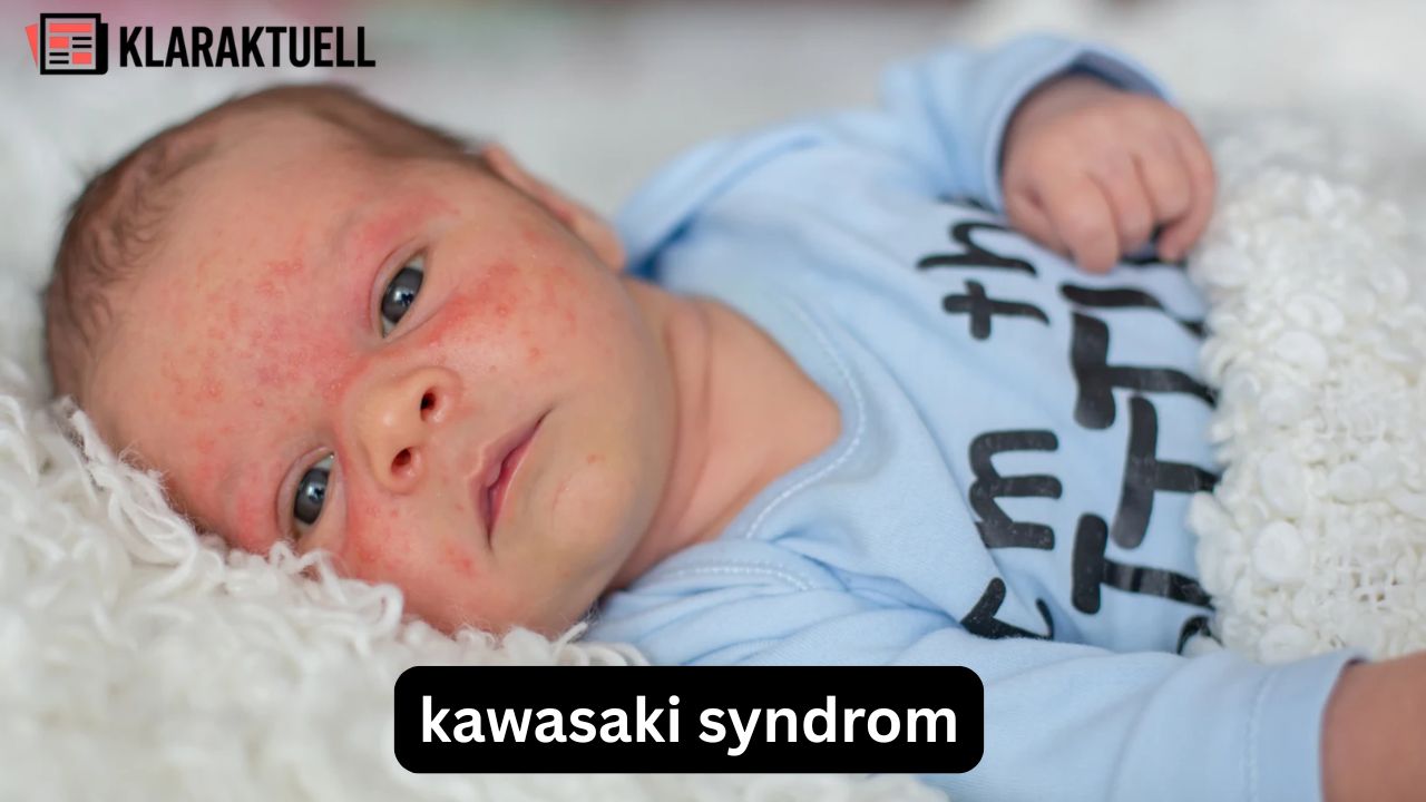 Kawasaki-Syndrom